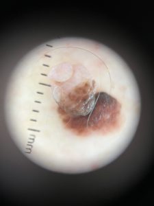 Dermatascope images Colchester & Chelmsford