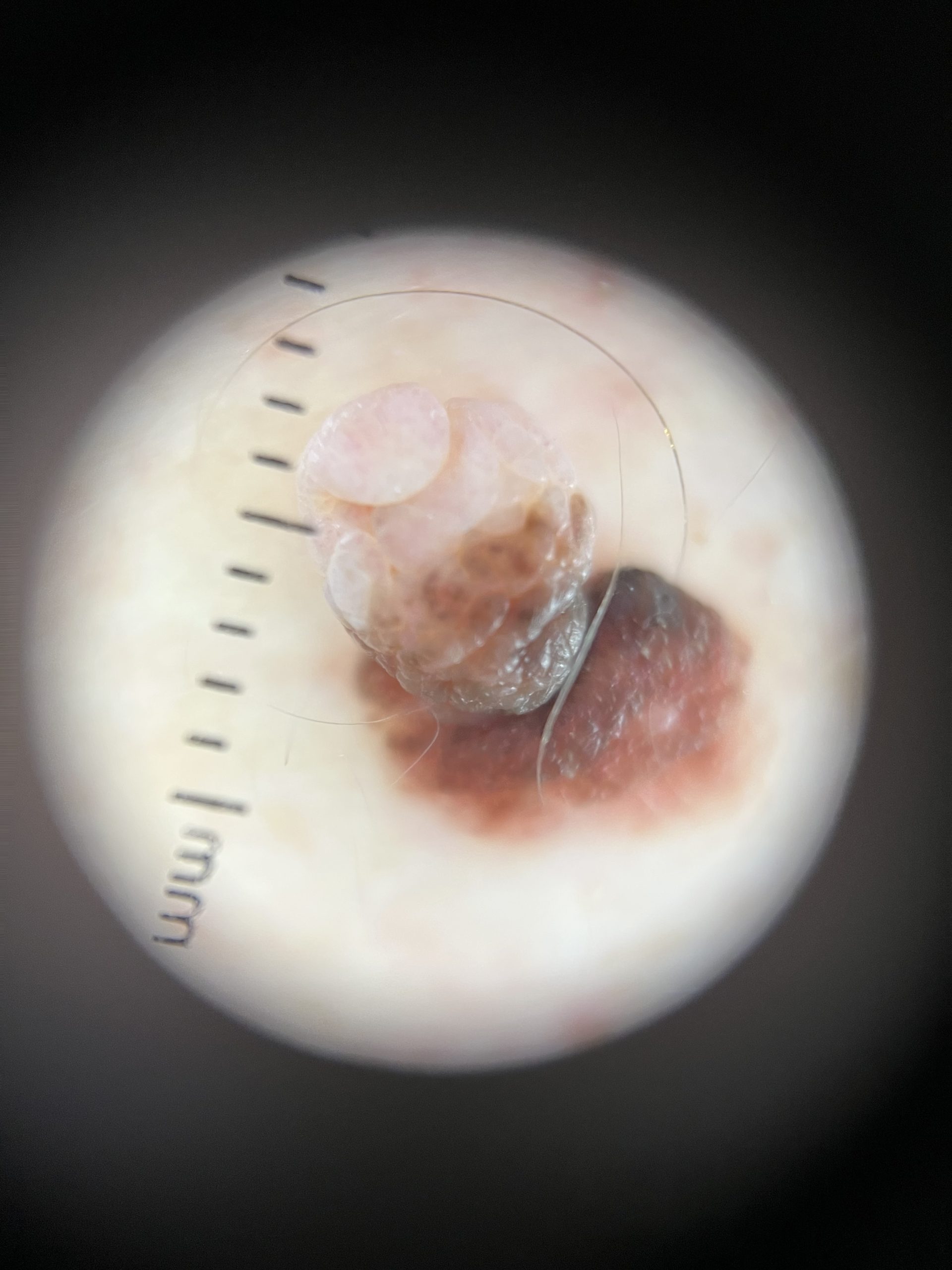 Dermatascope images Colchester & Chelmsford