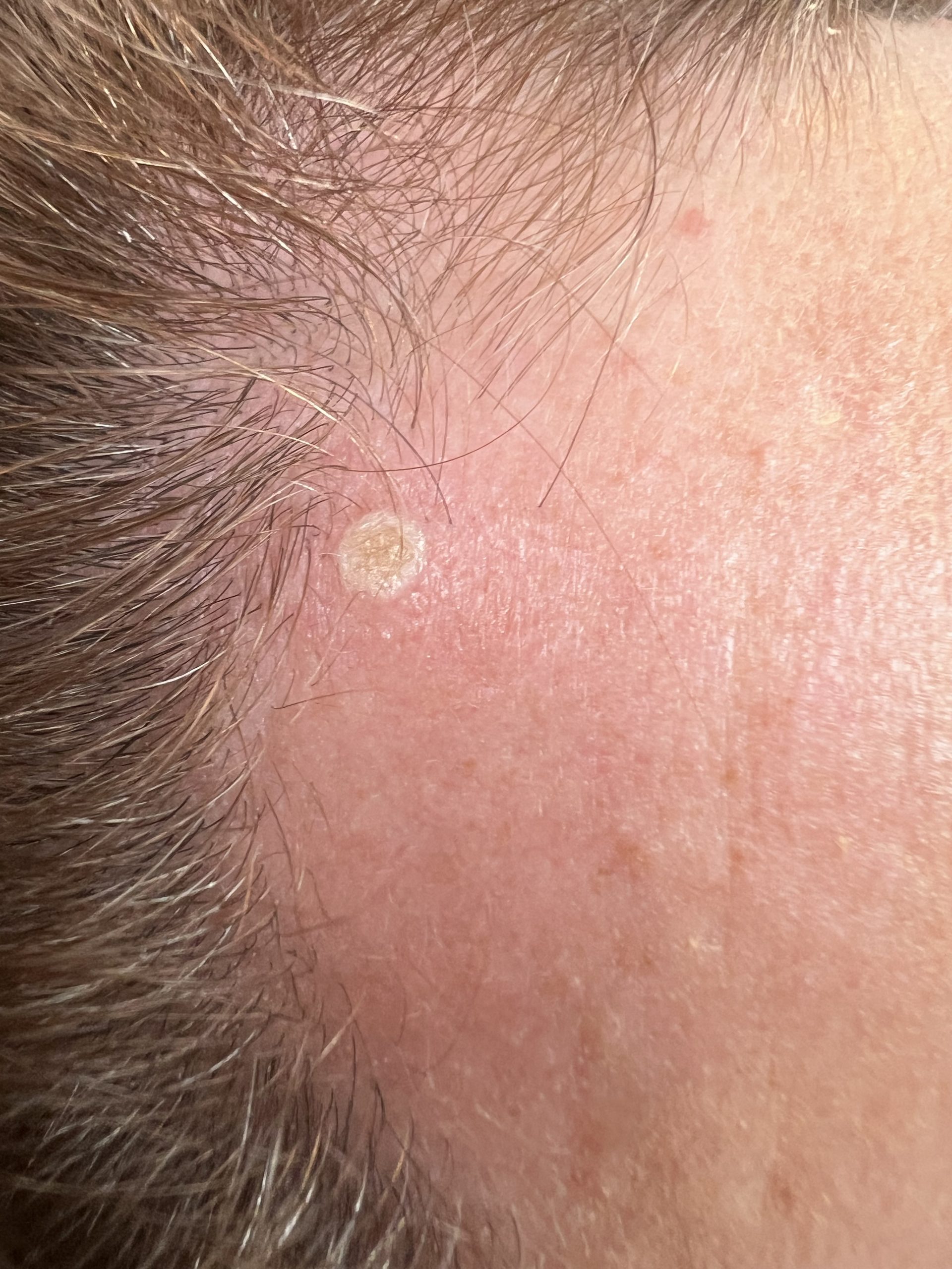 Blemish Immediately Post Treatment