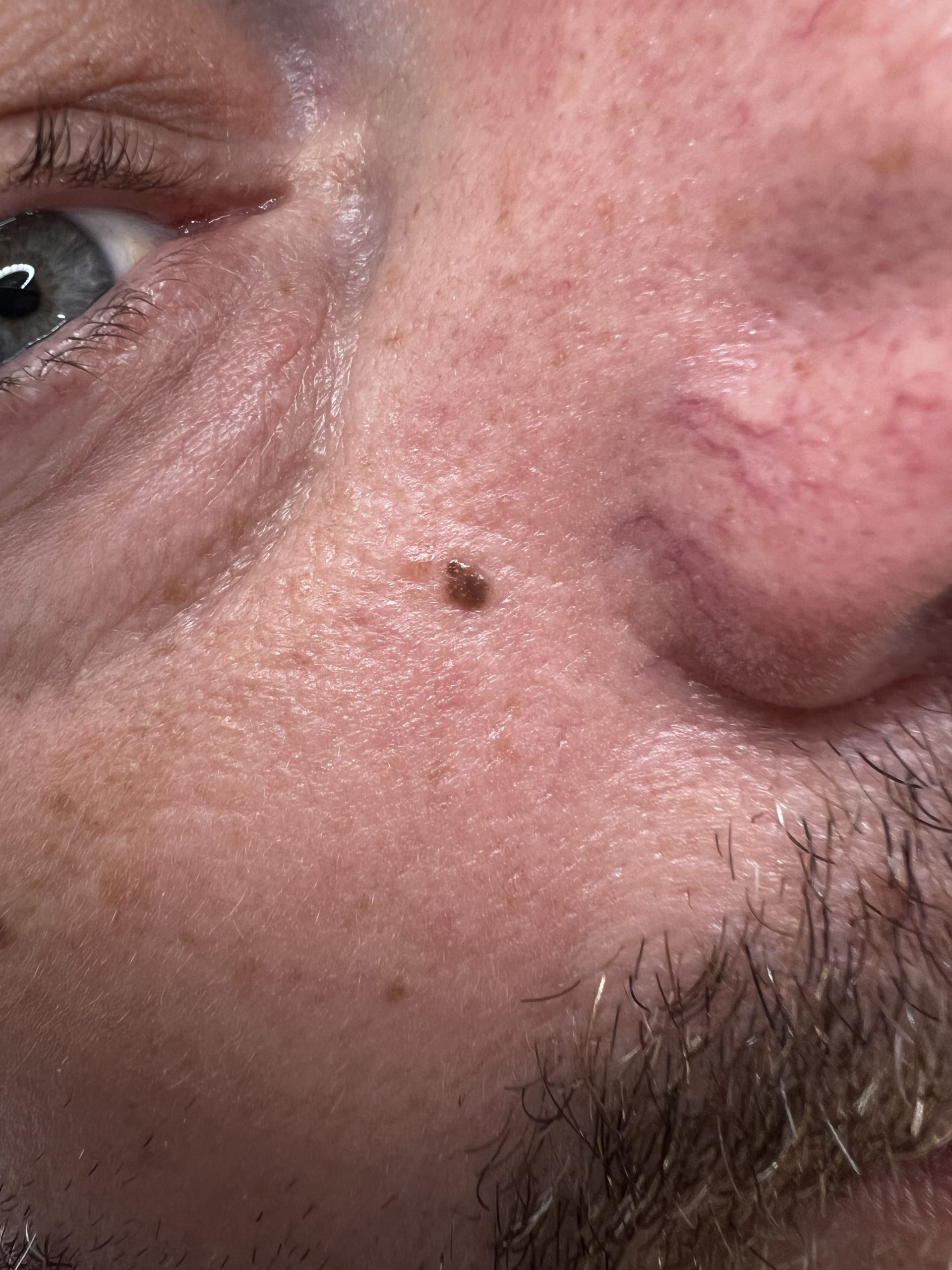 small blemish removal colchester & chelmsford