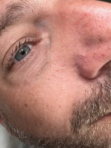 small blemish removal colchester & chelmsford 