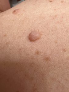Mole treatment, Colchester & Chelmsford