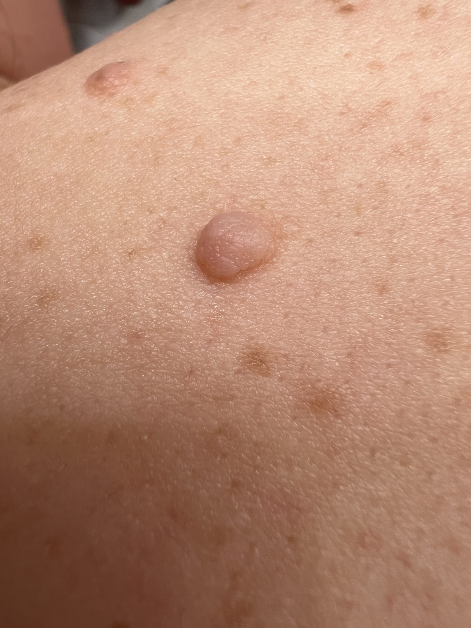 Mole treatment, Colchester & Chelmsford
