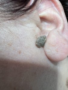 Seborrheic Keratosis removal, Colchester & Chelmsford