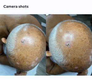 Aggrevated Seborrheic Keratosis
