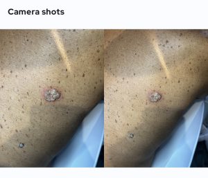 Squamous Cell Carcinoma