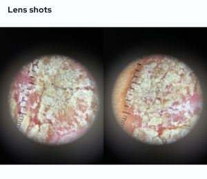 Squamous Cell Carcinoma