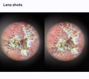 Aggrevated Seborrheic Keratosis