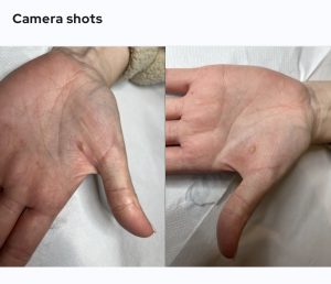 Mole Treatment