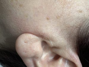 Seborrheic Keratosis removal, Colchester & Chelmsford 