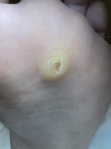 Verruca treatment Colchester & Chelmsford Clinics