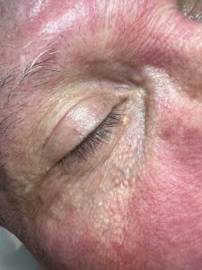 Xanthelasma treatment Colchester & Chelmsford Clinics