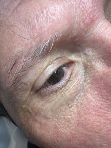 Xanthelasma treatment Colchester & Chelmsford Clinics 