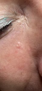 Sebaceous Hyperplasia