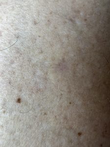 Bowens Disease post treatment of Efudix