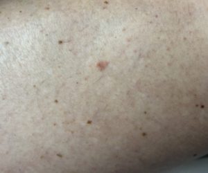 Skin checks Colchester & Chelmsford