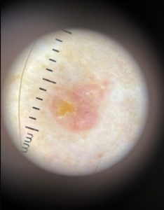 Dermatascope Image
