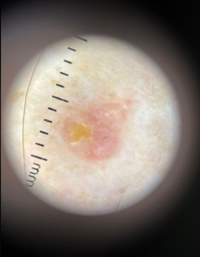 Dermatascope Image