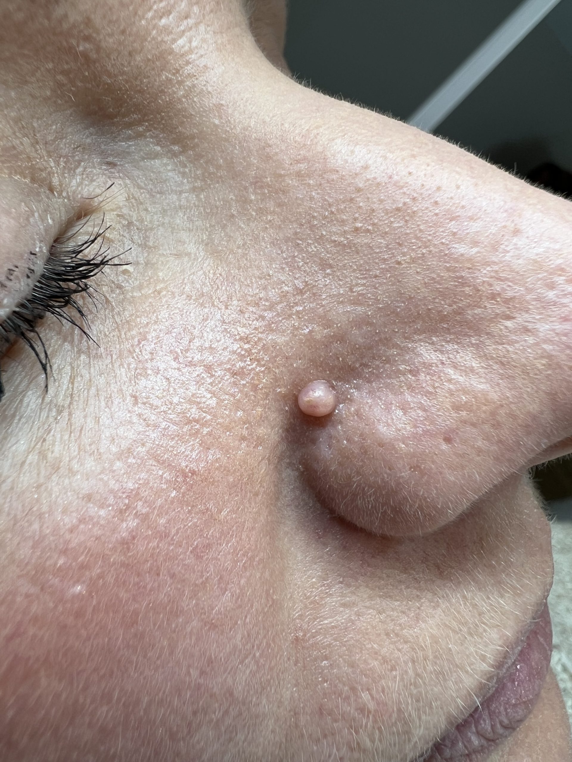 Fibrous Papule Reduction