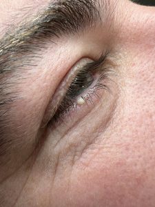 Milia Removal Colchester & Chelmsford