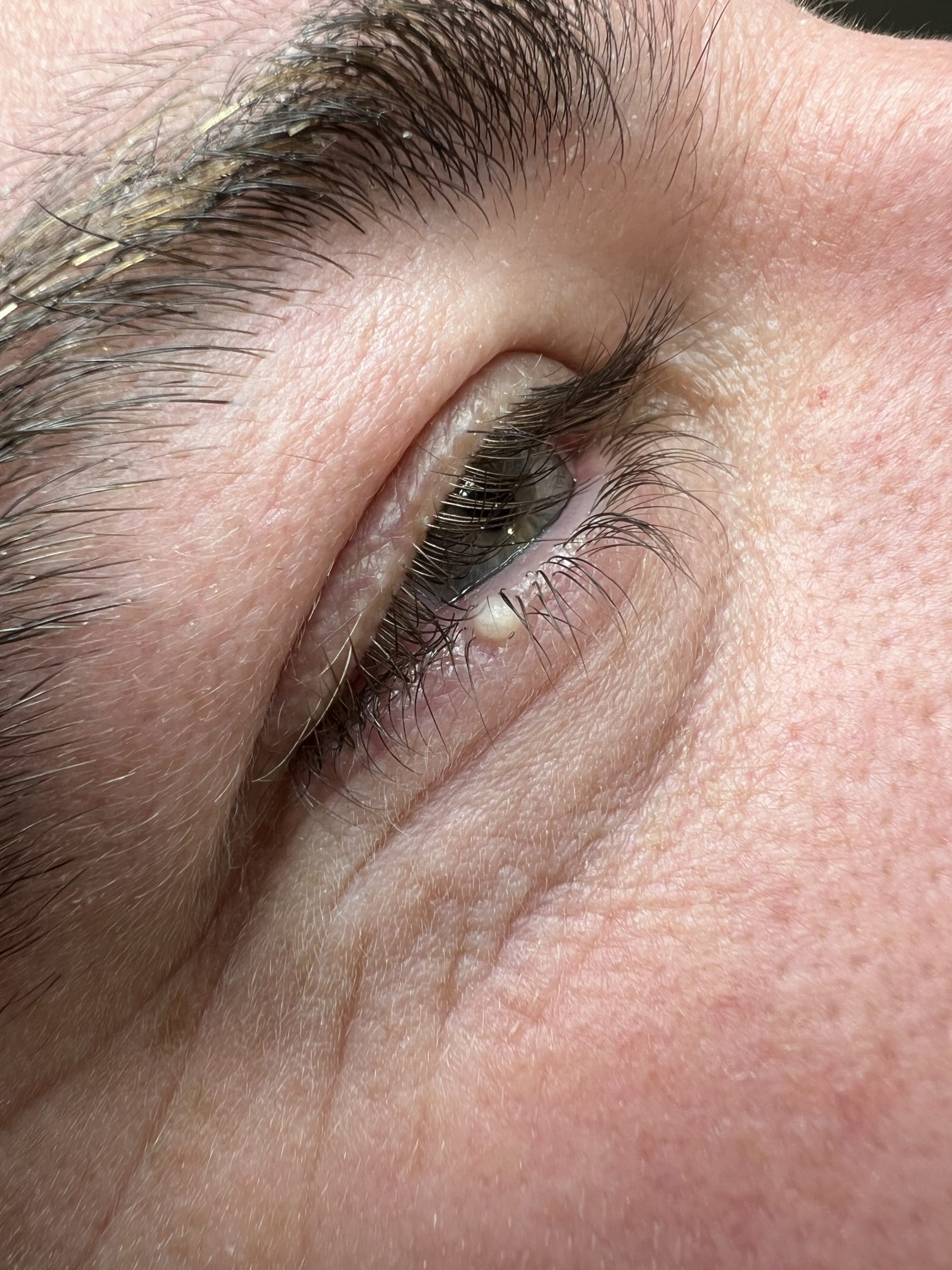 Milia Removal Colchester & Chelmsford