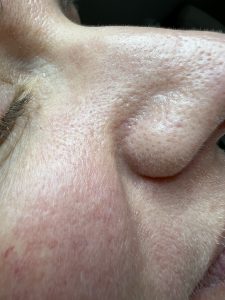 Fibrous Papule Reduction