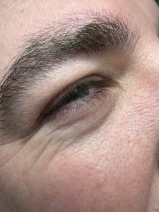 Milia Removal Colchester & Chelmsford