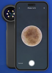 mole & blemish checks Colchester & Chelmsford