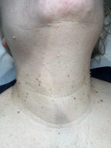 Skin Tags & Filiform Warts