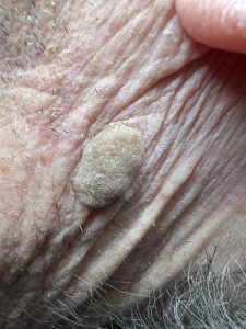 Healing of Blemish Removal
