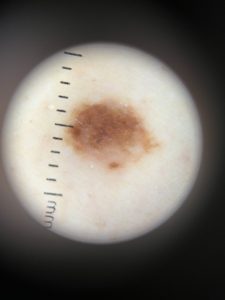 Dematascope image mole