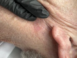 Healing of Blemish Removal