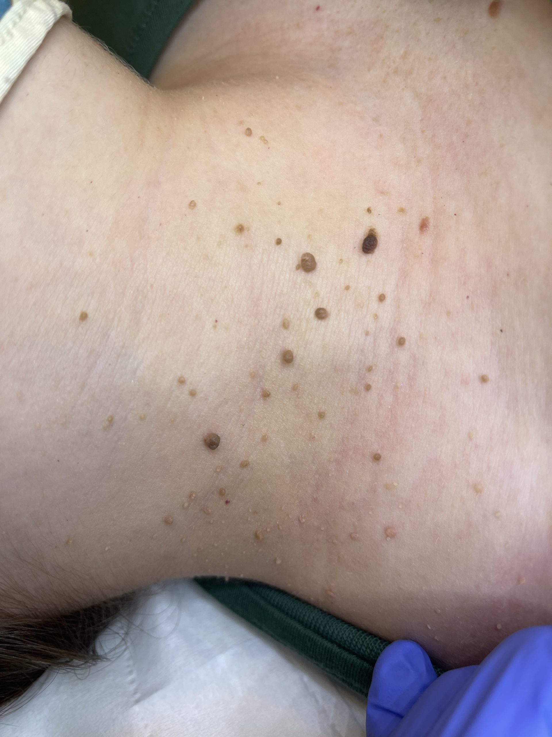 Why am I getting Skin Tags?