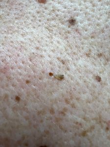 Pore of Winer Removal, Colchester & Chelmsford Clinics.