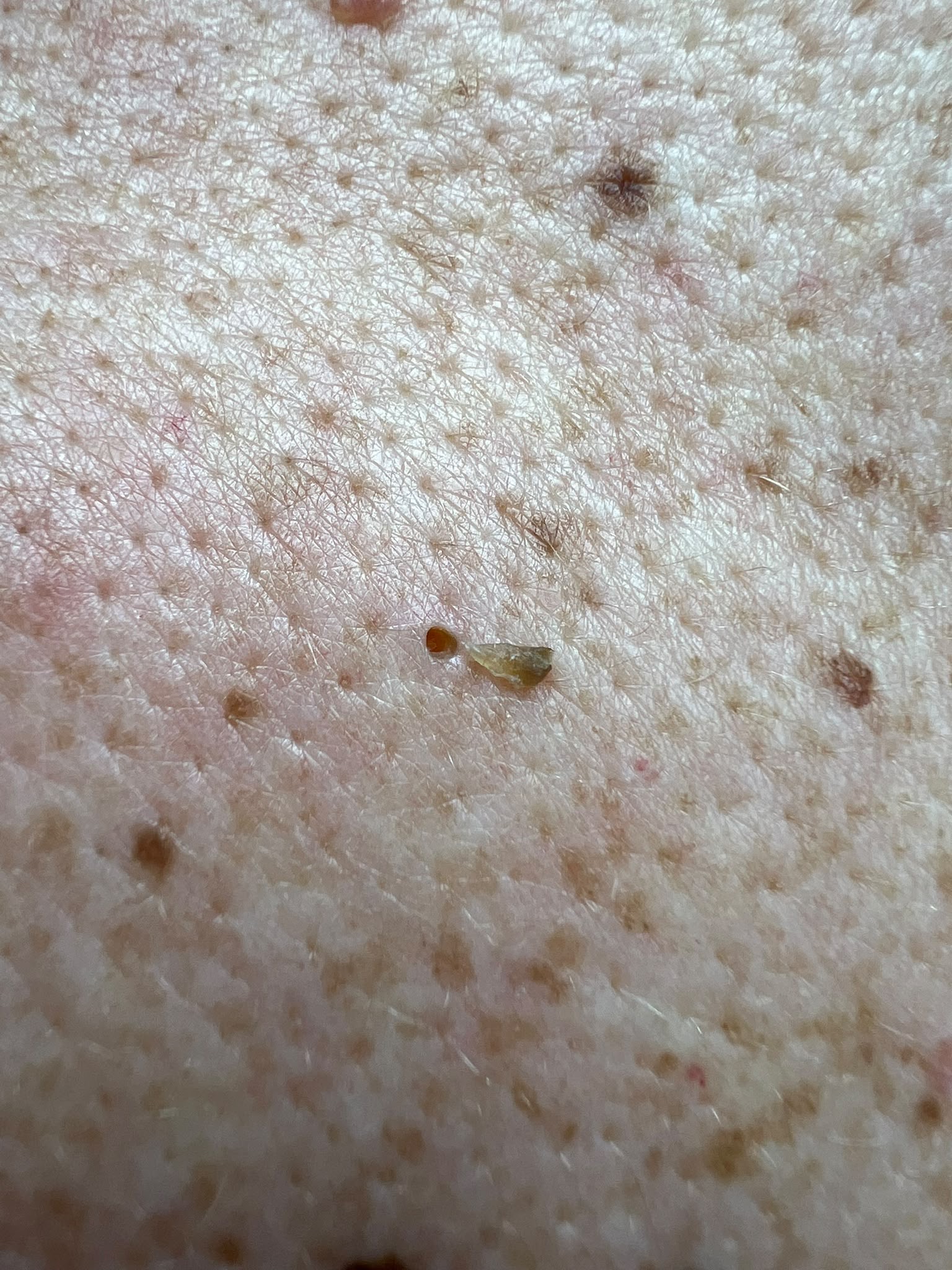 Pore of Winer Removal, Colchester & Chelmsford Clinics.