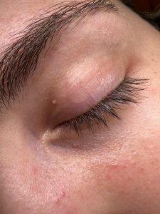 Example of one small milia on the eyelid