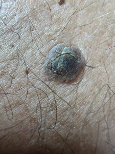 Example of a seborrheic keratosis showing crusty, scaly, stuck-on appearance