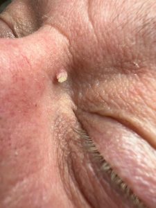 Example of a filiform wart on the side of the nose showing rough, thread-like texture
