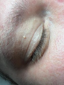 Example of skin tags on the eye area