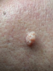 Example of a filiform wart on the cheek, showing prong like projections, with a cauliflower appearance