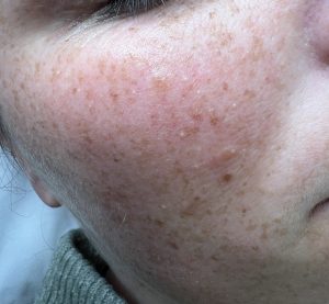 Example of mulitple milia on the cheek area