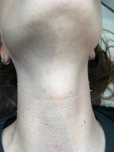 Before and after photo of skin tag removal treatment on a client, Amy Gordon Advanced Cosmetics, Colchester and Chelmsford clinic