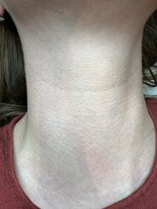 After photo of skin tag removal treatment on a client, showing beautiful, healed & clear skin. Amy Gordon Advanced Cosmetics, Colchester and Chelmsford clinic