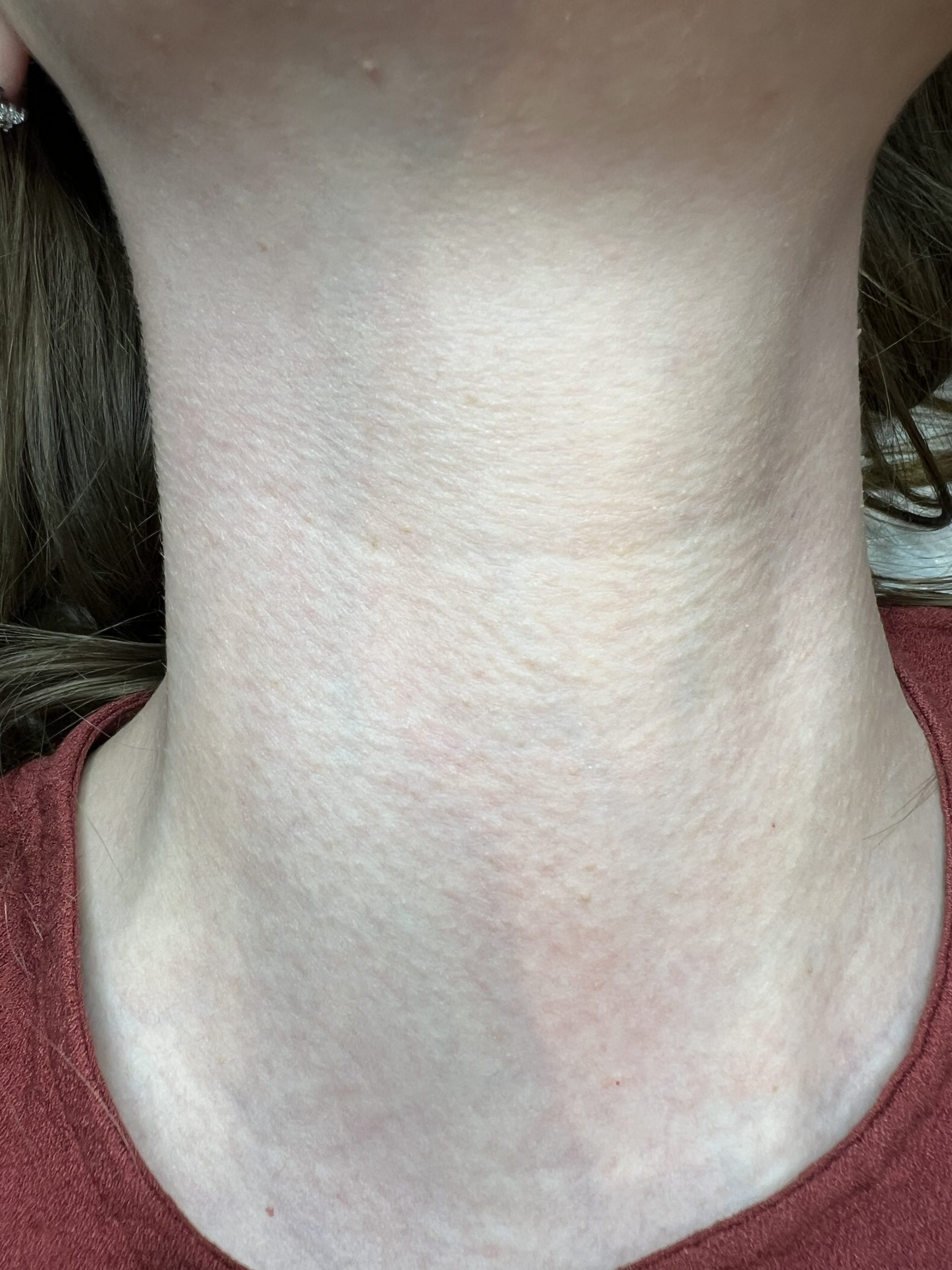 After photo of skin tag removal treatment on a client, showing beautiful, healed & clear skin. Amy Gordon Advanced Cosmetics, Colchester and Chelmsford clinic