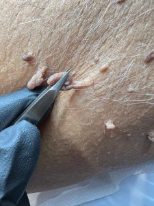 Example of skin tags on the underarm showing typical soft, hanging appearance