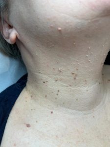 Example of skin tags on the neck