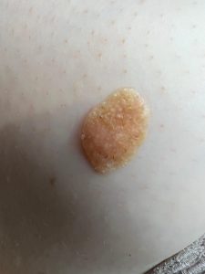 Example of a seborrheic keratosis showing a waxy, light brown appearance