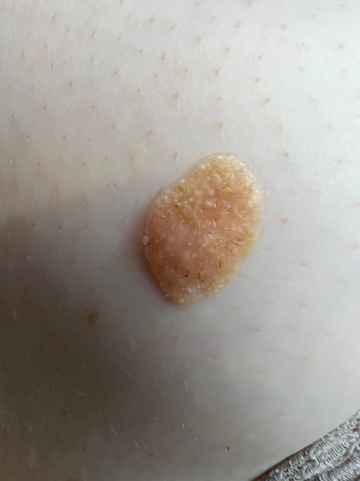 Example of a seborrheic keratosis showing a waxy, light brown appearance