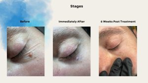 A real case from my Colchester clinic. A gentleman who thought he had a skin tag, but it was a wart under the eye. See the full healing journey in photos