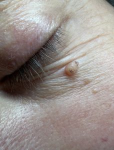 Wart under the eye before professional removal treatment at Amy Gordon clinic Colchester